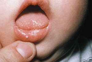Фото гингивита у детей во рту